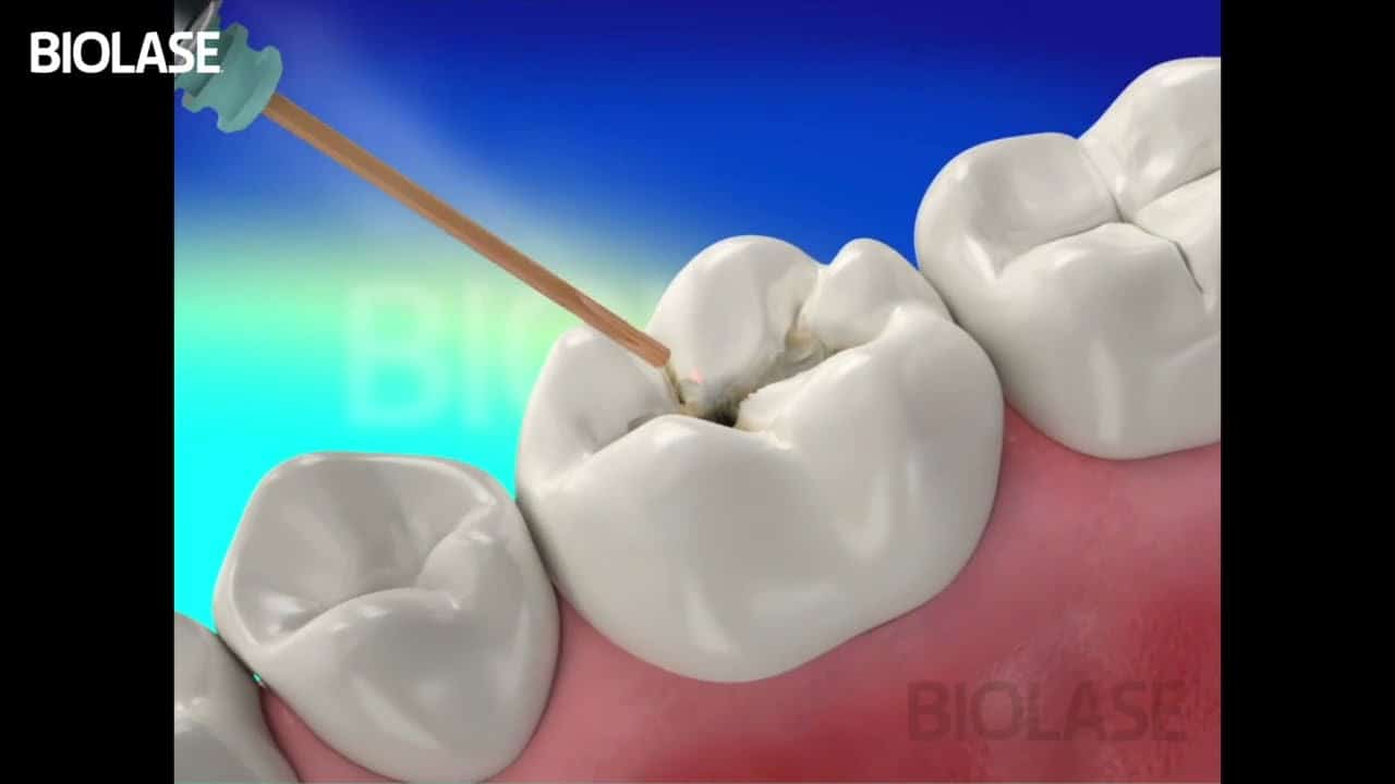 Caria dentară fără freză și fără durere? Află cum funcționează tratamentul cu laser în 2025 1 carie dentara laser