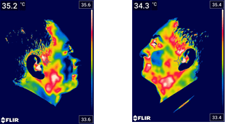 termografie fata dupa prima sedinta