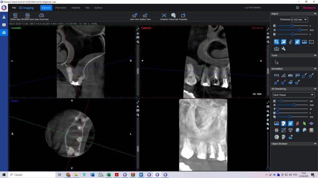 Fig. 1 Imagine CBCT inainte de tratament – perforatia si sinusul infectat