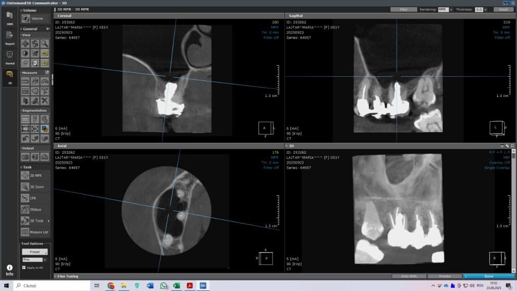 Fig. 2. CBCT la 9 luni – dintele salvat si sinus vindecat