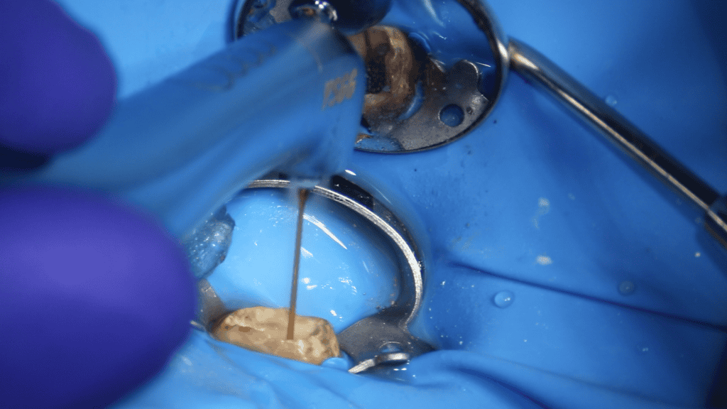 Fig. 4. Aplicarea laserului pentru curățare și îndepartarea țesutului afectat