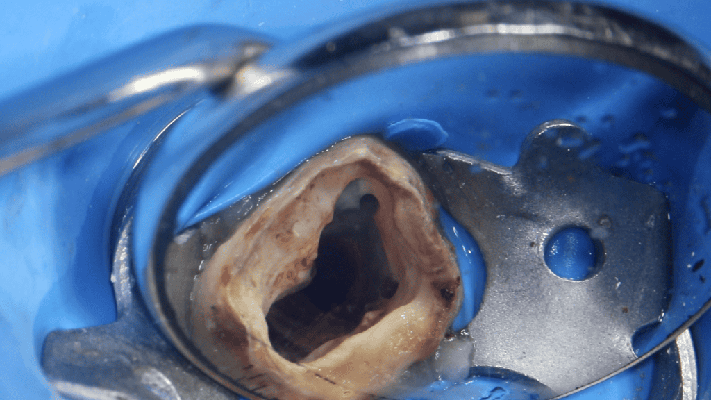 Fig. 5. Dintele pregătit pentru obturarea rădacinii.