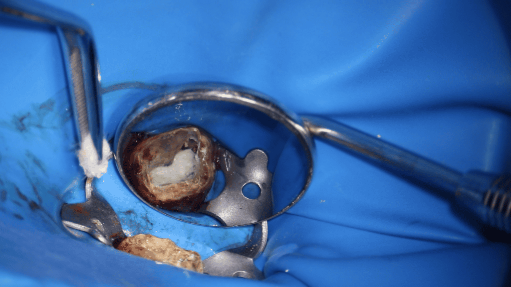 Figure 6. Reconstrucția zonei afectate cu MTA