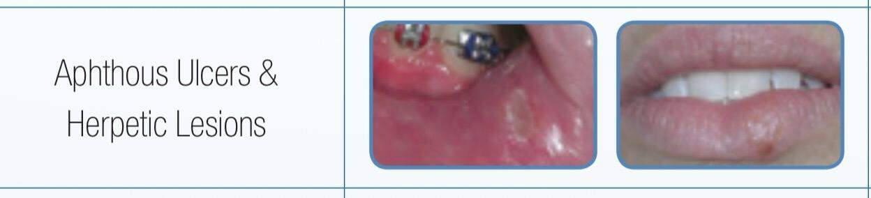 herpes & afte