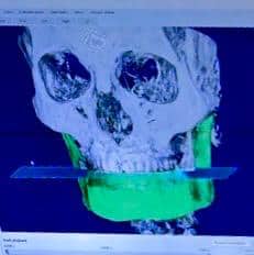 pozitia functionale ideale