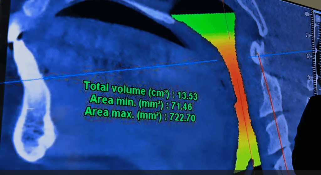 reduce frecventa episoadelor de apnee si hipopnee