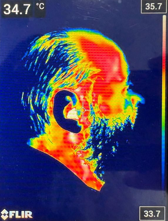 termografie laser faciala