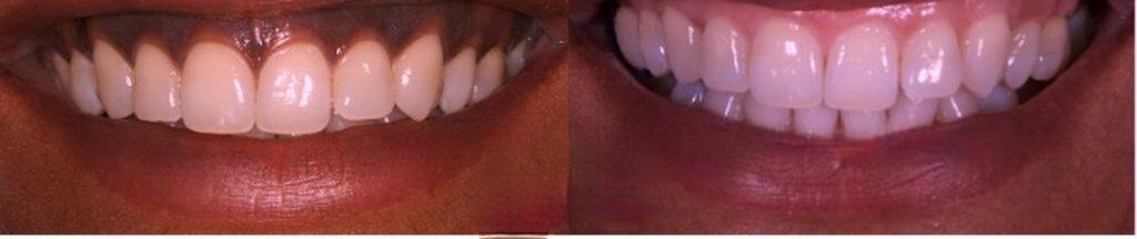 voucher depigmentare gingivala