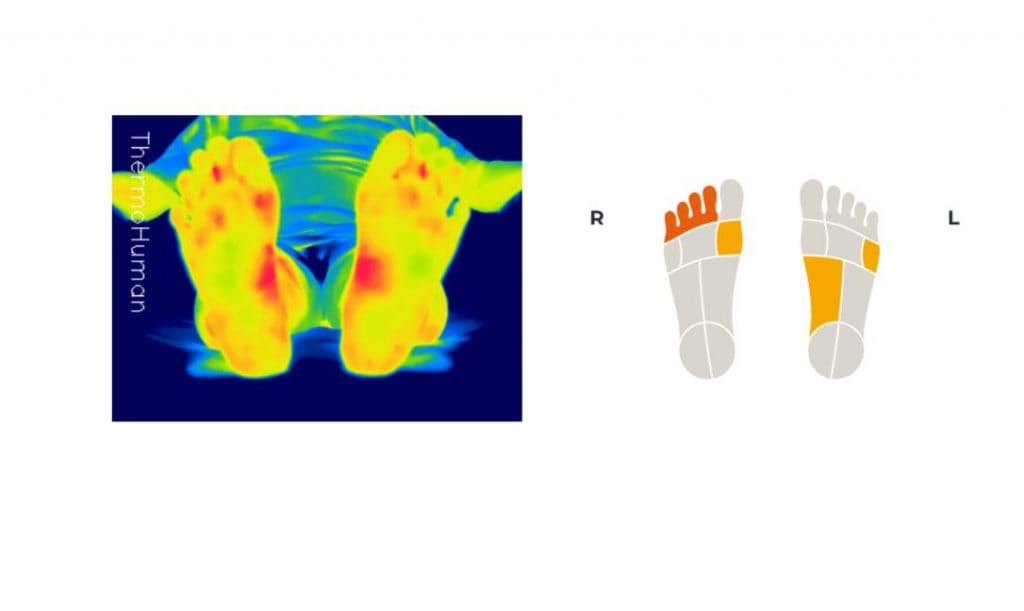 Analiza termografică posturală asistată AI2 dezechilibre ale corpului și tălpilor în disfuncțiile ATM-2