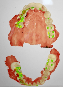 Hartă ocluzală digitală contactele dentare relevante în disfuncțiile ATM