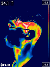 Termografie faciala dupa tratamentul laser partea dreapta