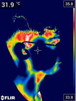 Termografie faciala dupa tratamentul laser partea stanga