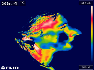 Termografie facială harta termică a musculaturii masticatorii în disfuncțiile ATM