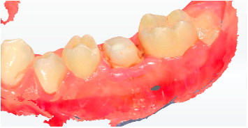 Dupa tratamentul endodontic si reconstructia coronara