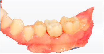 Faza finala – Restaurarea protetica definitiva