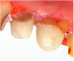 Figura 3 – Reconstructia coronoradiculara