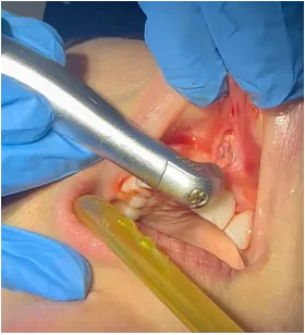 Frenectomie – LASER Erbium