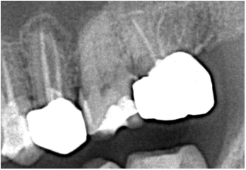 Radiografia 1 – Înainte de retratament