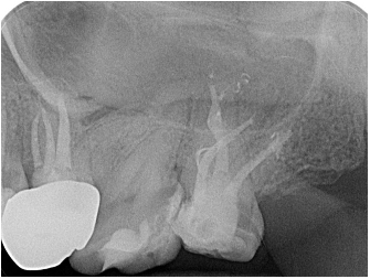 Radiografia 2 – După retratament