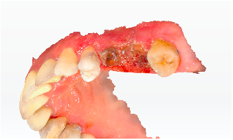 igura 2 – Dupa tratamentul endodontic