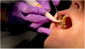 The importance of digital periodontal probing